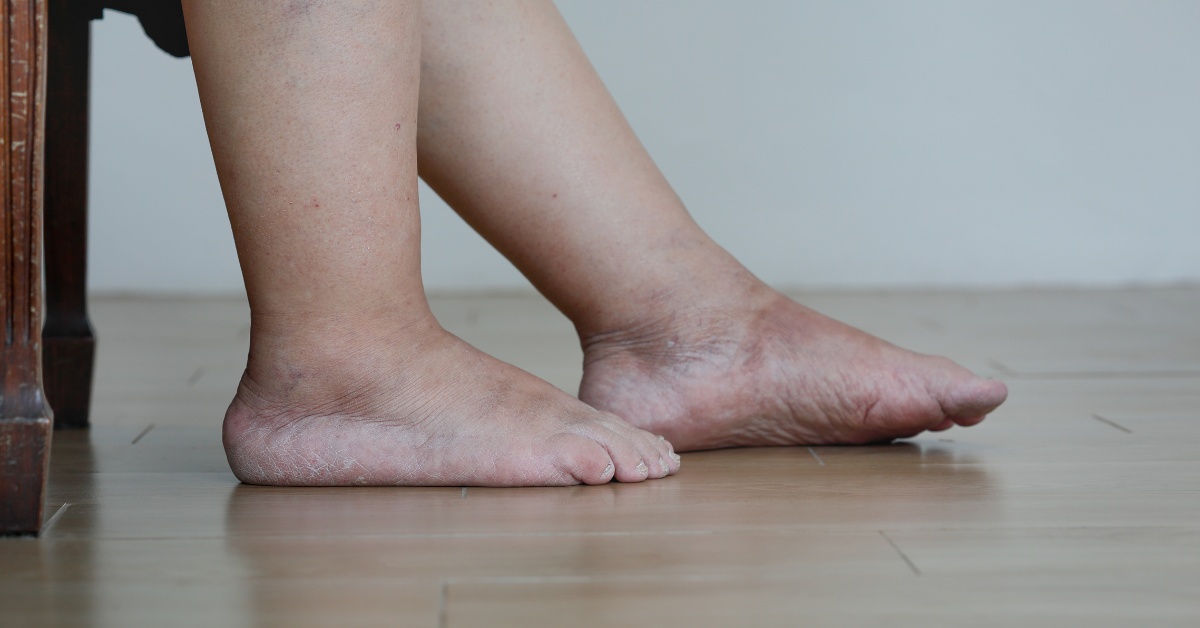 Piernas hinchadas en una persona adulta, imagen informativa utilizada por Farmavari para contenidos de salud y bienestar